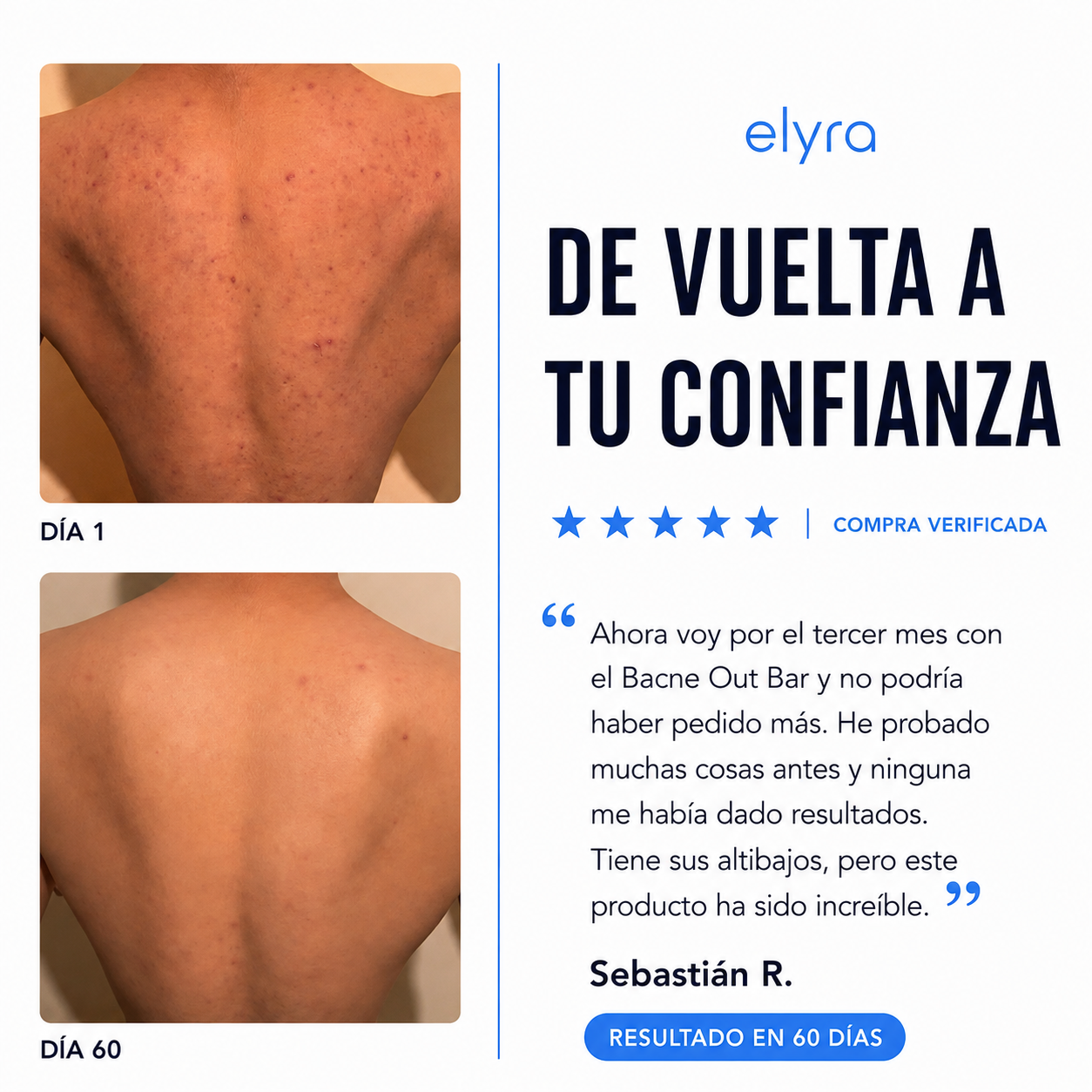 Elyra barra natural para combatir el acné corporal